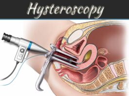 What Is Hysteroscopy: Process, Uses And Risk Factor