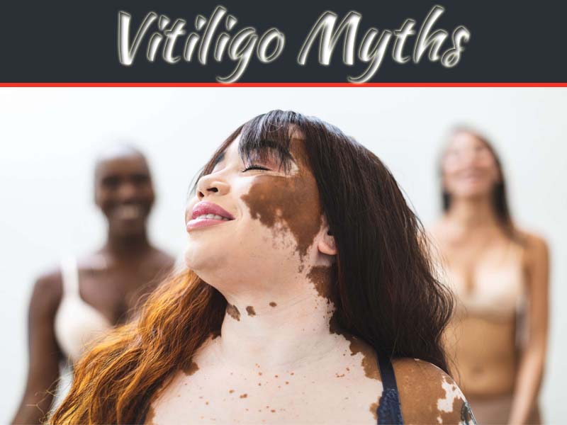 Bursting The Myths Associated With Vitiligo