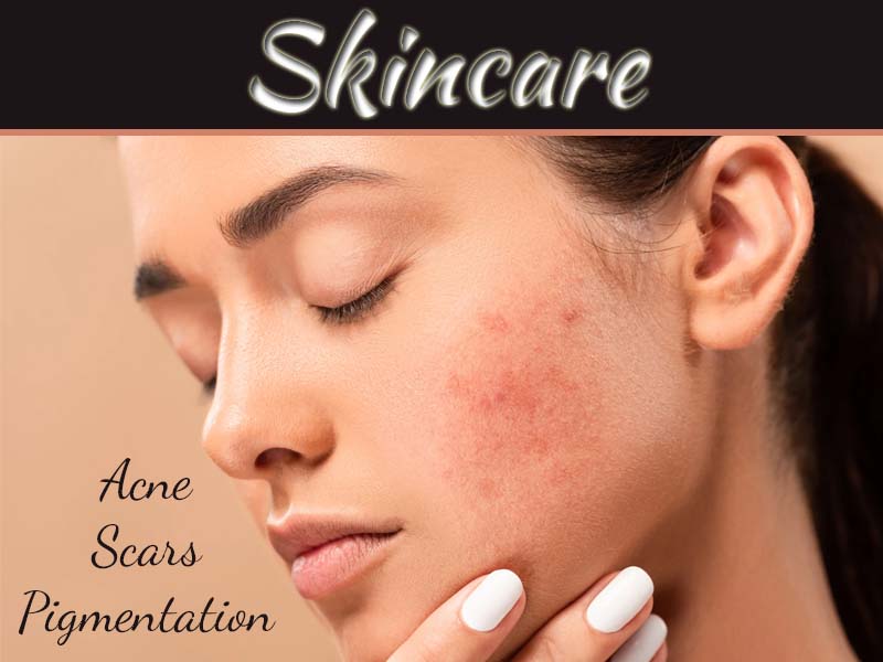How To Get Rid Of Acne Scars And Fade Pigmentation Fast?