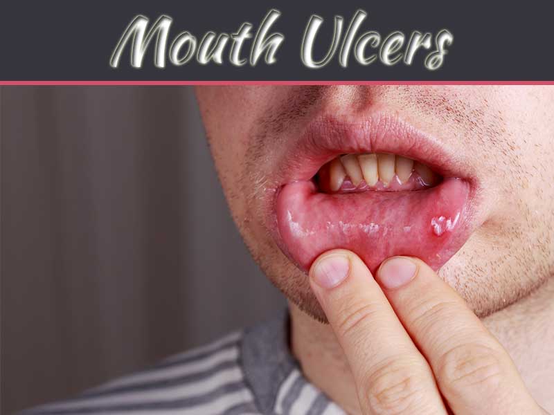 Mouth Ulcers- Causes And Treatment
